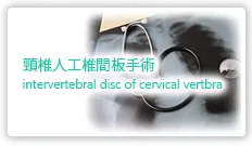 頸椎人工椎間板手術